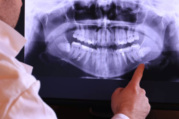 Best Emergency Wisdom Teeth Removal in Bradford, TN