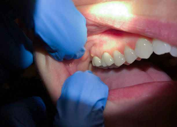 Best Emergency Broken Tooth Repair in Bradford, TN
